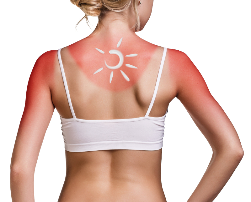 πλάτη γυναίκας με ηλιακά εγκαύματα